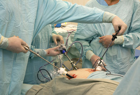 Bariatric Stomach Surgery