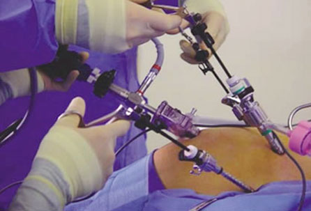 Gastric Bypass Stomach Surgery