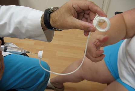 Side Effects of Stomach Surgery